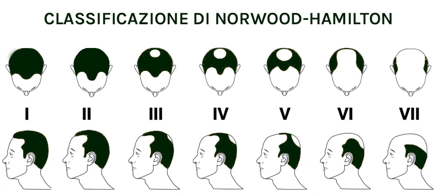Classificazione di Norwood-Hamilton: i 7 stadi della calvizie maschile, dallo stadio I al VII